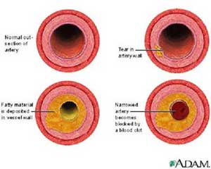 Stable Angina